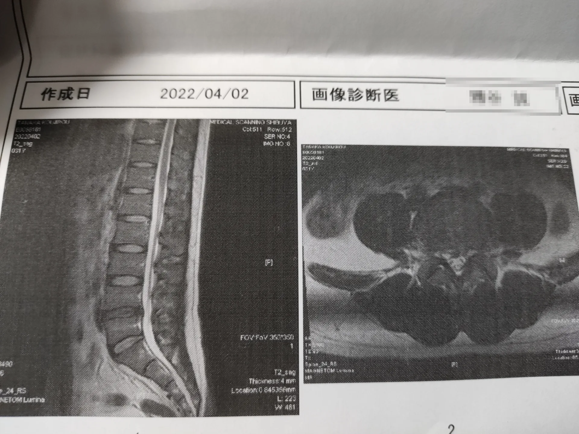 腰椎椎間板ヘルニアの1つの例